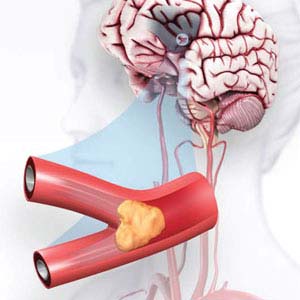 brain stroke treatment in guntur