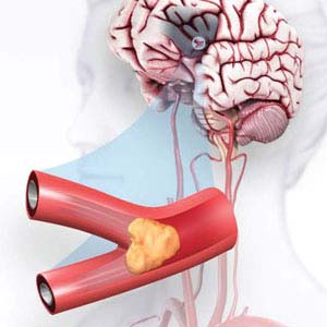 stroke treatment in guntur